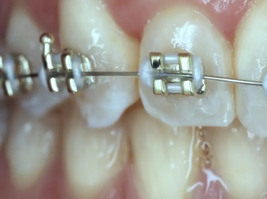 Detalle de brackets en diantes