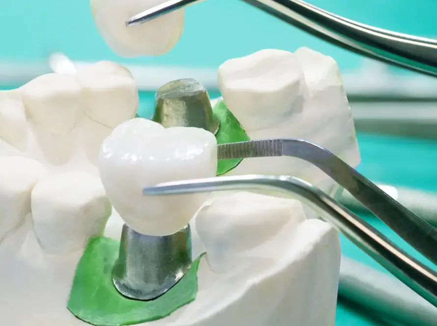 Extracción de muela de un molde